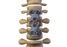 Anterior Cervical Discectomy and Fusion