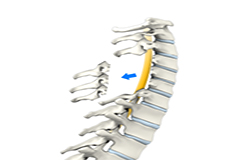 Cervical Laminectomy