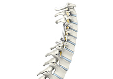 Posterior Cervical Fusion