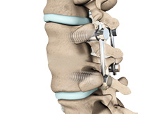 Posterior Lumbar Fusion