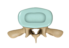 Spinal Stenosis