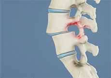 Spondylolisthesis